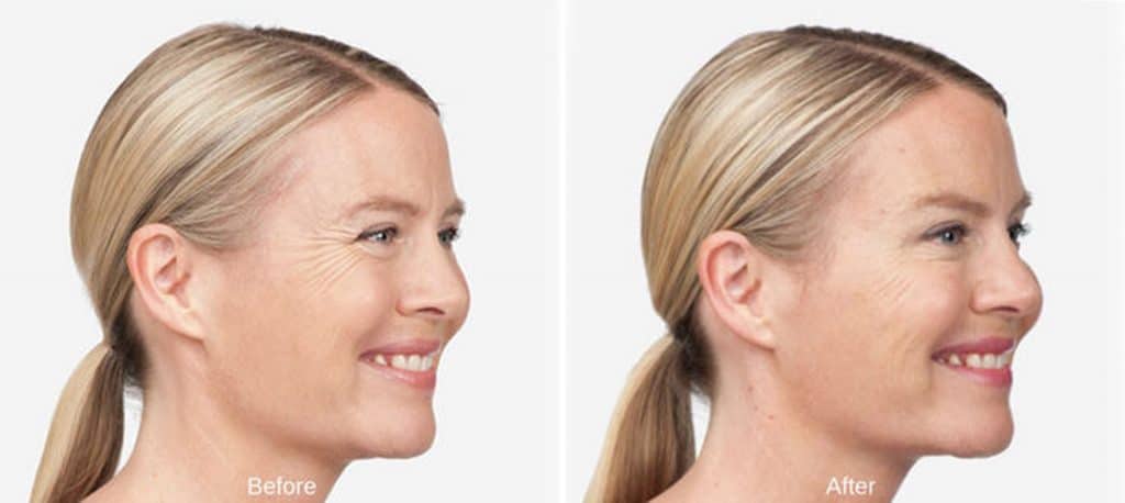 botox before and after Lux Skin & Lasers 3