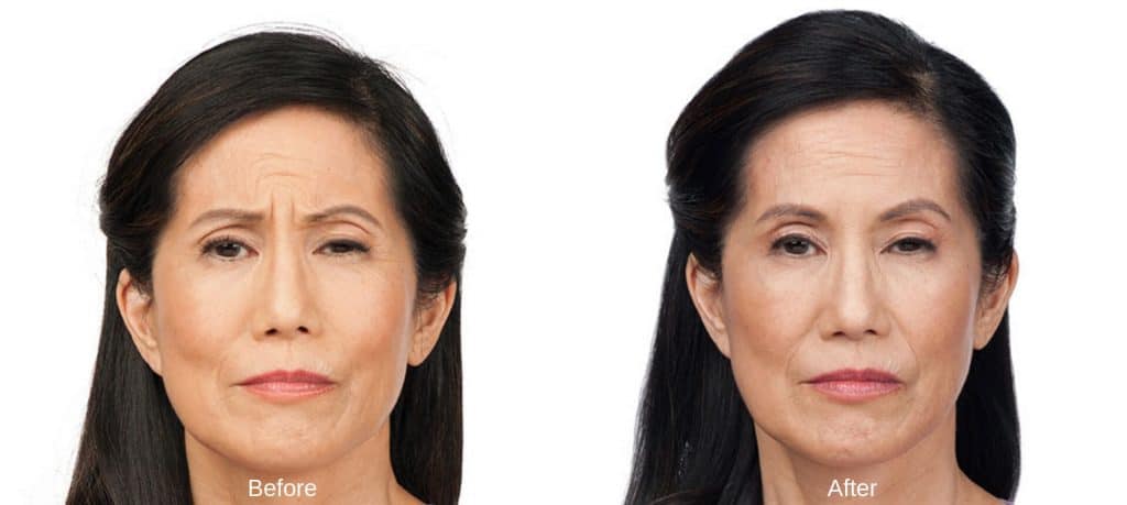 botox before and after 3 1024x459 1