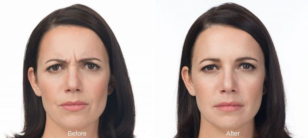 botox before and after Lux Skin & Lasers 3