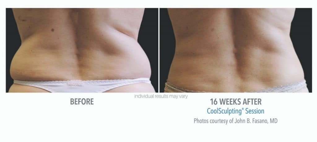 coolsculpting 12 before and afte