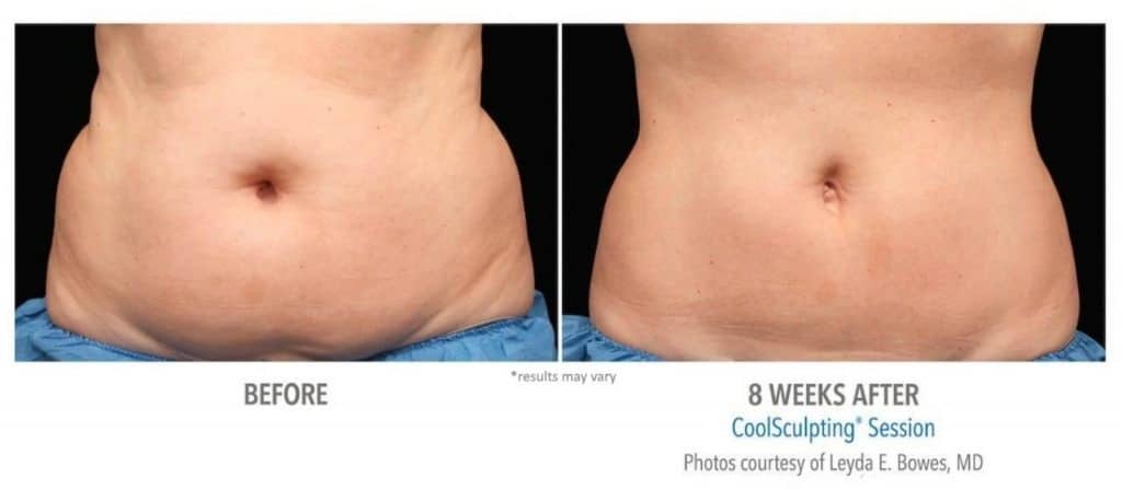 coolsculpting 13 before and afte