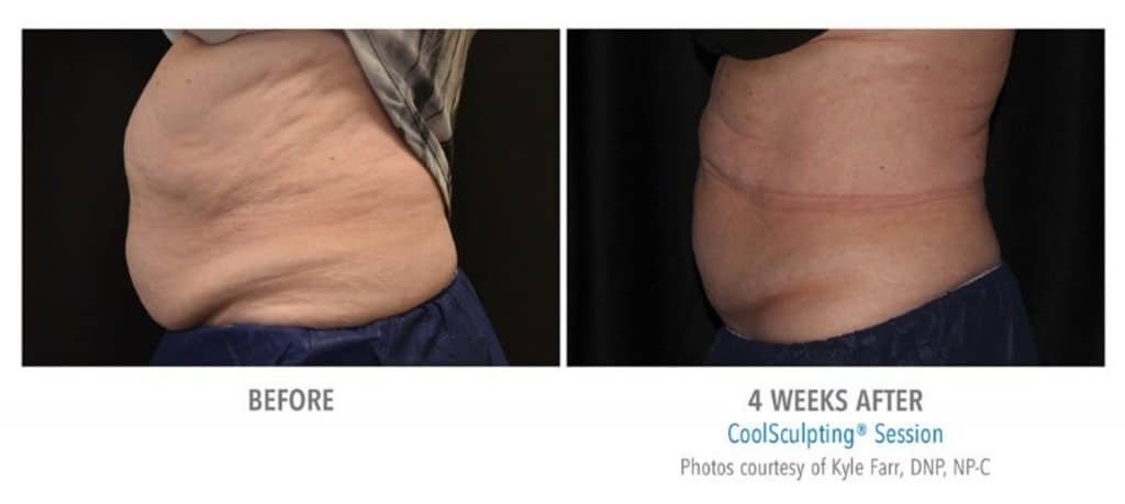 coolsculpting 4 before and after