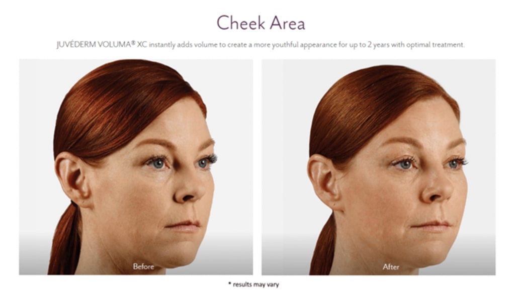 juvederm before and after lux skin & lasers 5