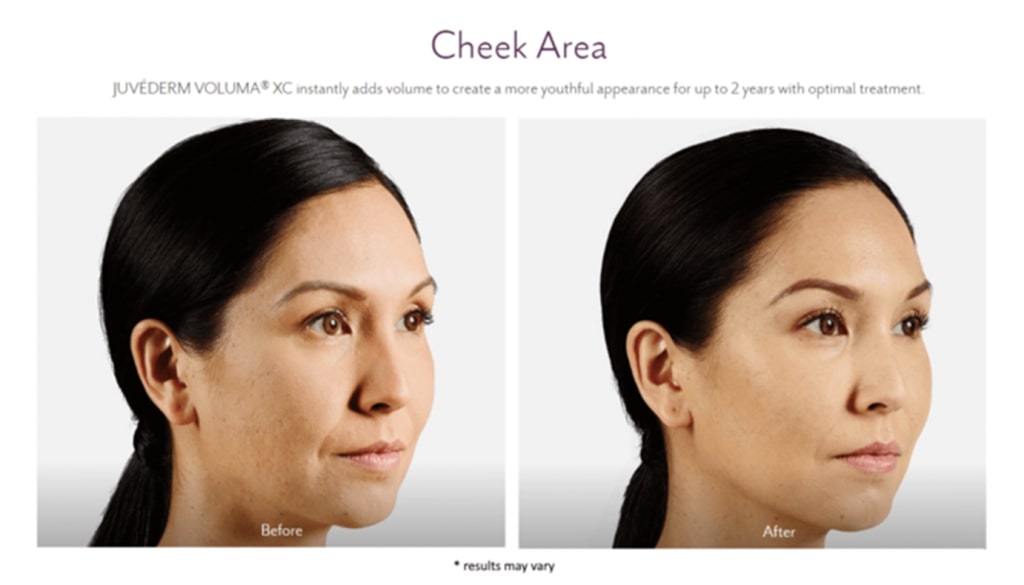 juvederm before and after lux skin & lasers 6