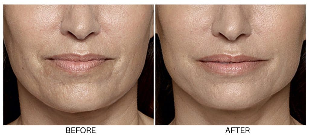 restalyne before and after lux skin & lasers 1