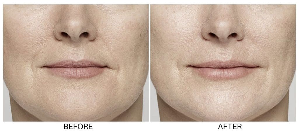 restalyne before and after lux skin & lasers 2
