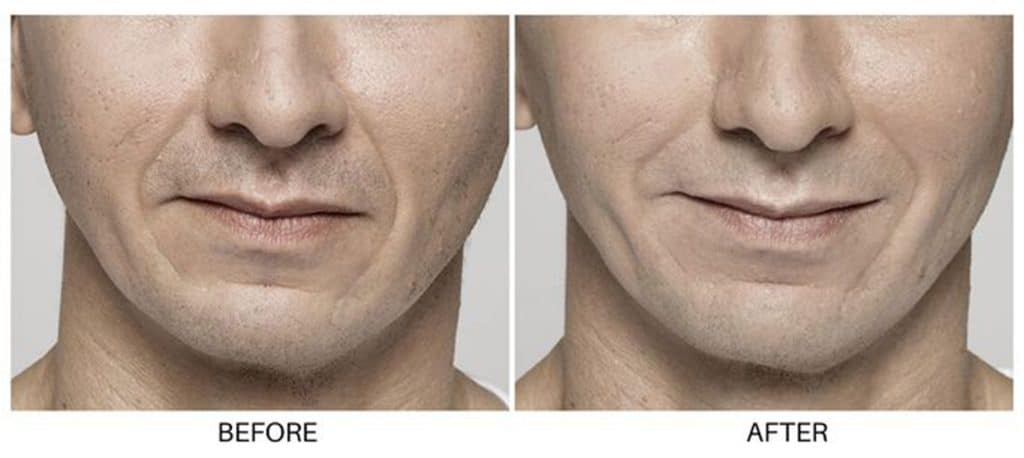 restalyne before and after lux skin & lasers 3