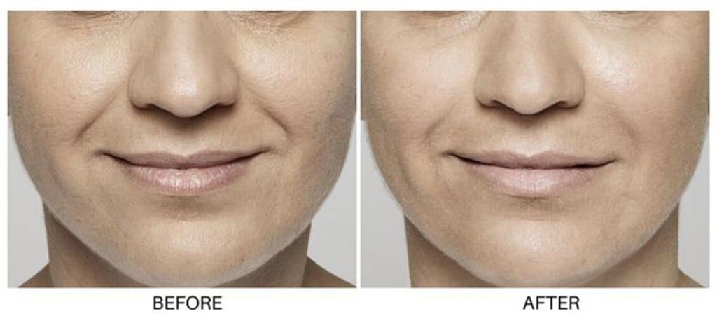 restalyne before and after lux skin & lasers 4